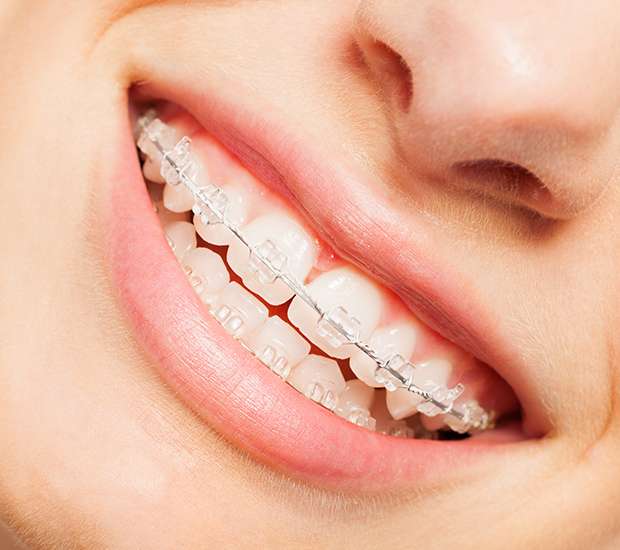 Santa Clarita Invisible Orthodontics