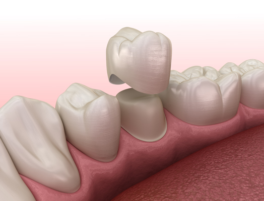 Dental Crowns And Front Teeth: What You Should Know