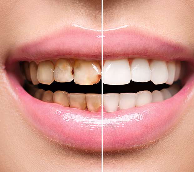 Santa Clarita Dental Implant Restoration