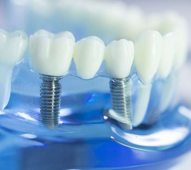 Santa Clarita Dental Implants