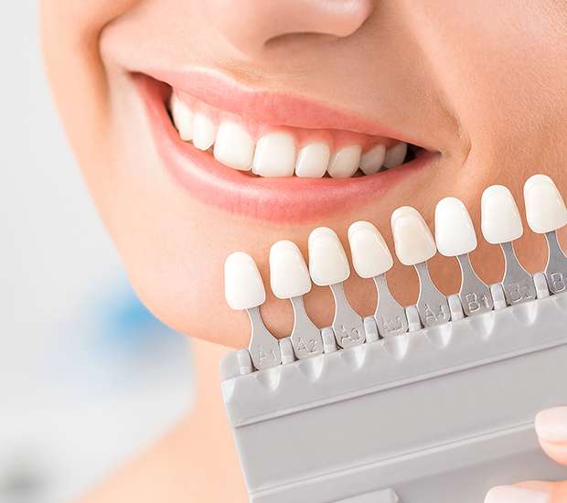 Santa Clarita Veneers