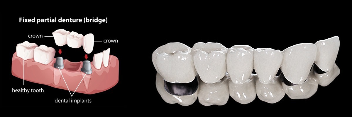Santa Clarita Dentures