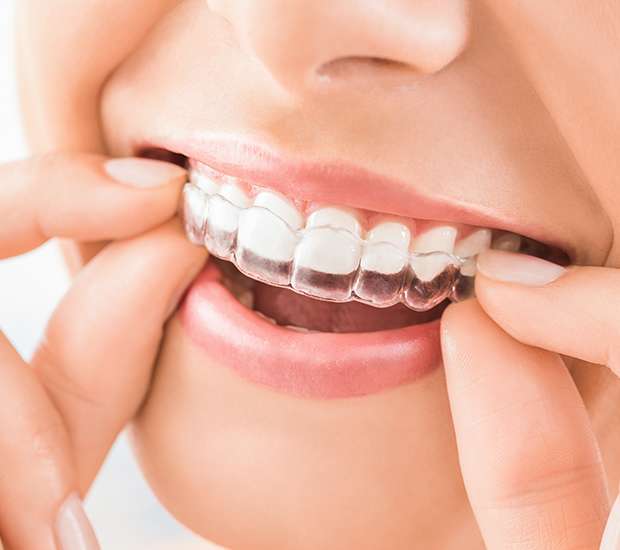 Santa Clarita Does Invisalign® Really Work?