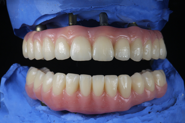 When Are Implant Supported Dentures Recommended?