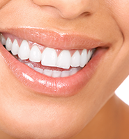 Teeth Whitening Services Santa Clarita, CA