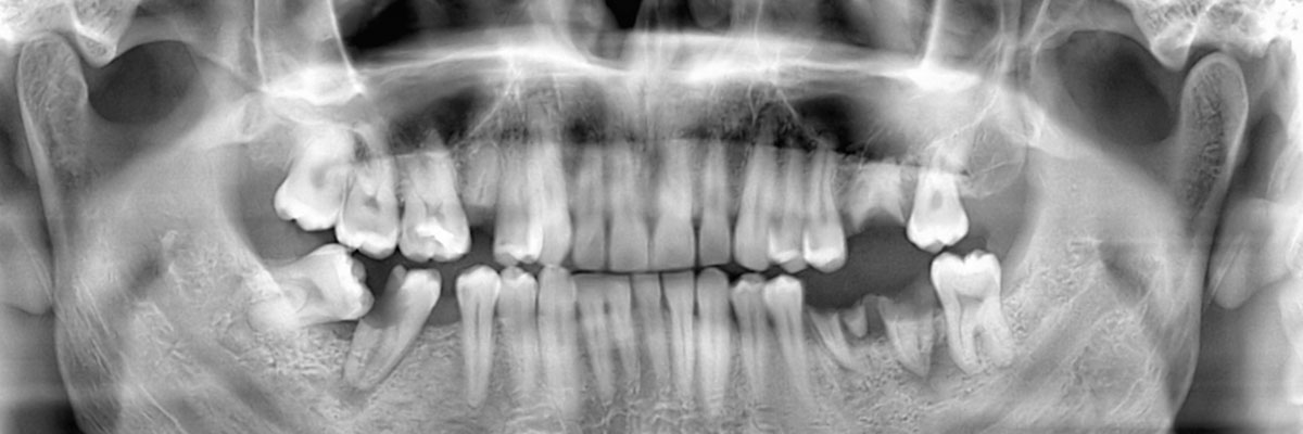 Santa Clarita Wisdom Teeth Extraction